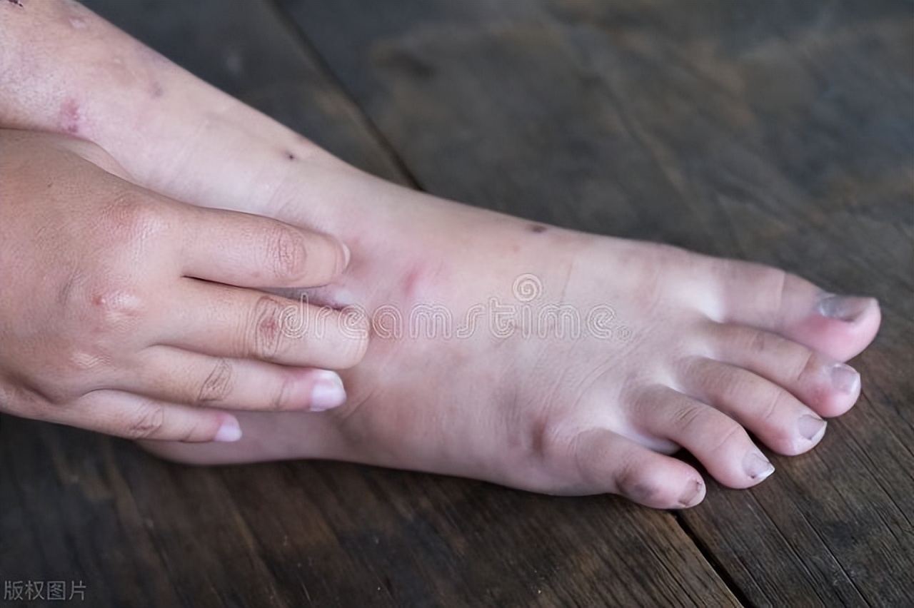 糖尿病足溃疡的科学护理：早期干预，重建足部健康