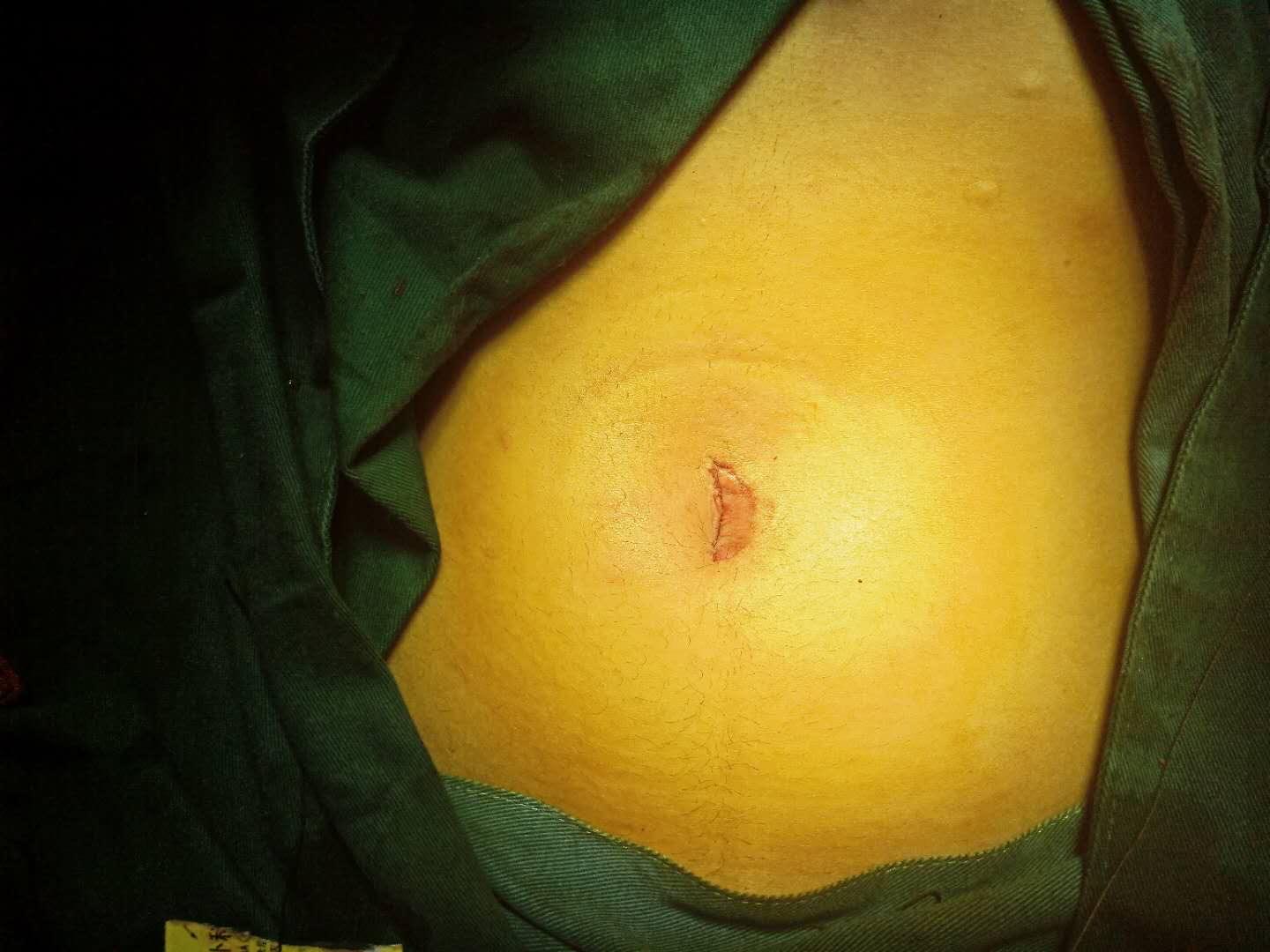 单孔腹腔镜不适合哪些妇科手术,妇科单孔腹腔镜