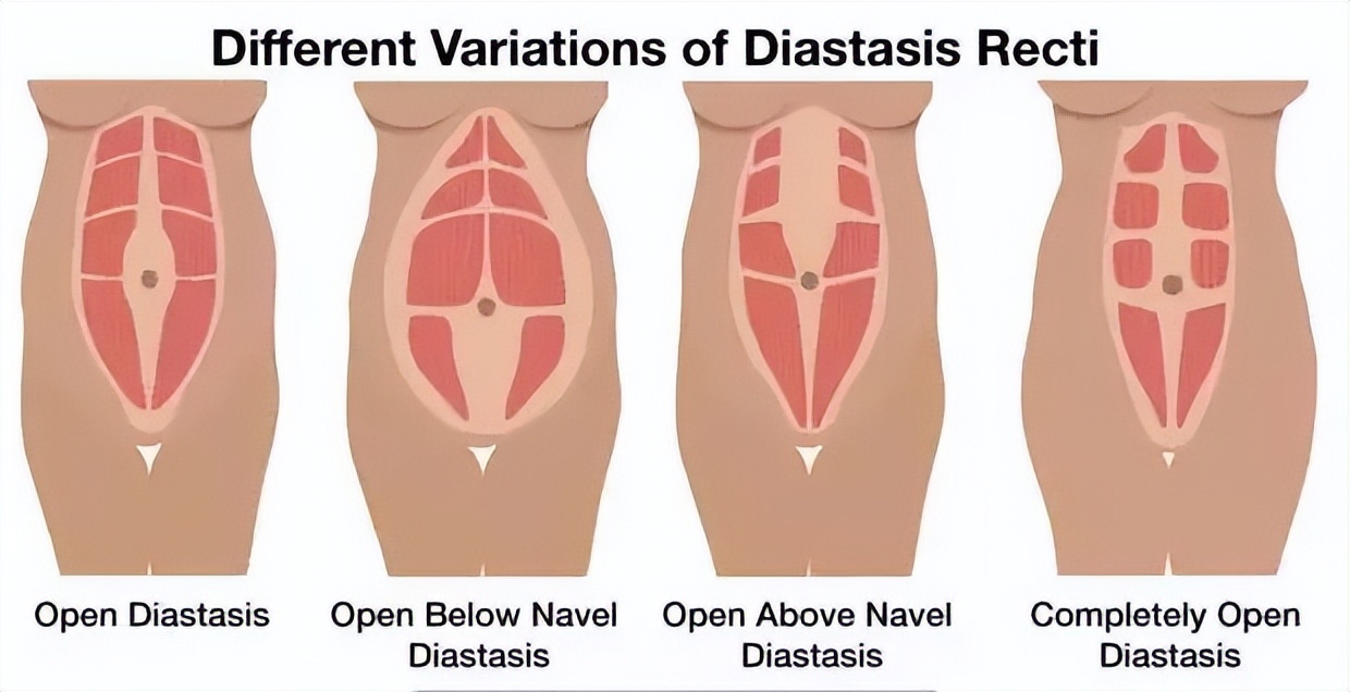 产后三个月能练刘畊宏吗,剖腹产多久可以练刘畊宏减肥操