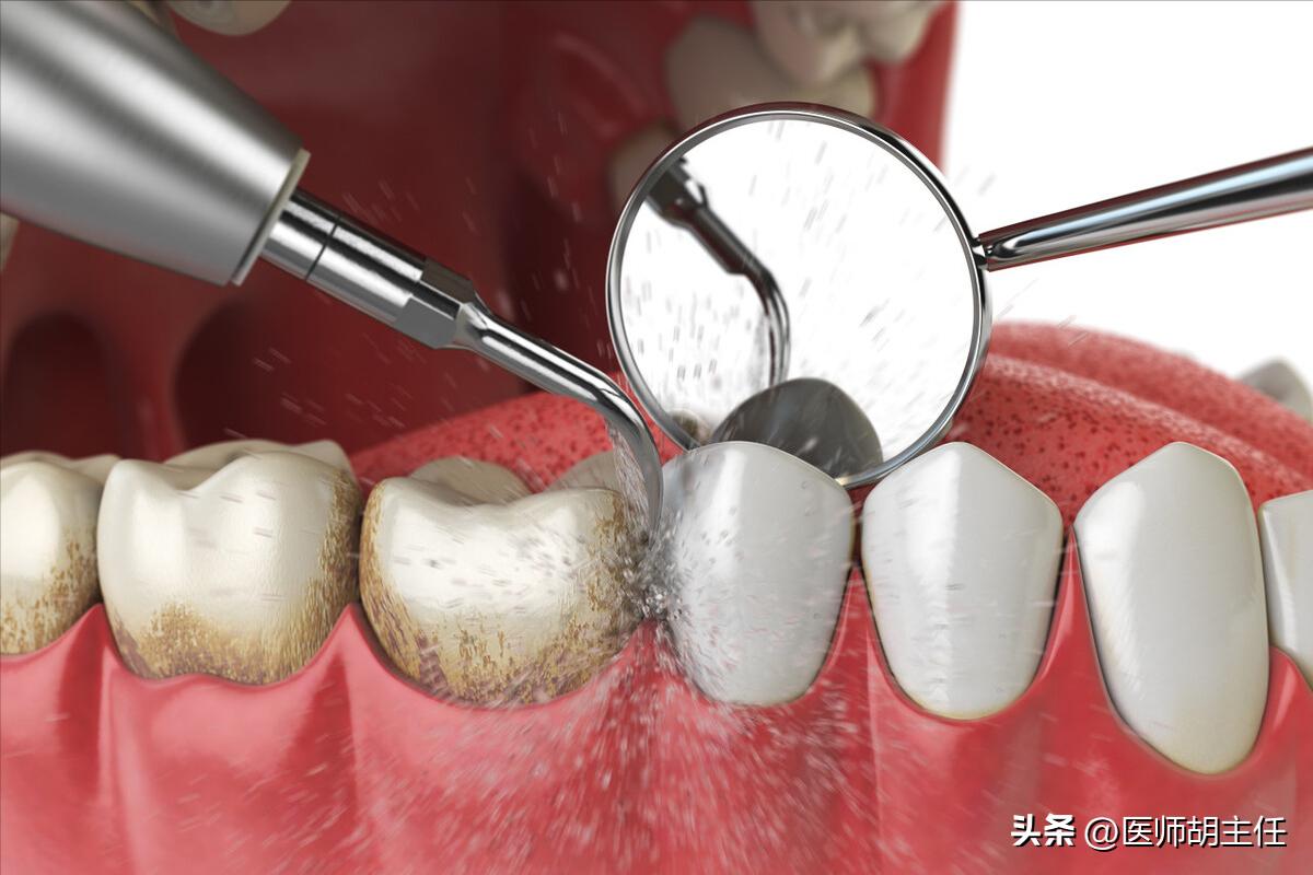 在牙缝里的牙结石要怎么去除,牙缝的牙结石怎么自己去除