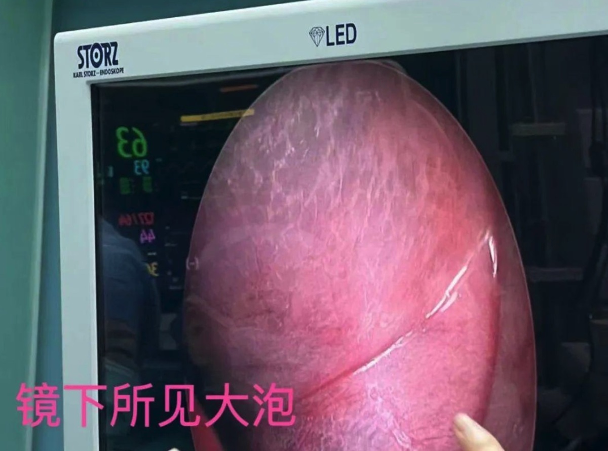 慢阻肺末期双肺移植,慢阻肺肺大泡手术有危险吗