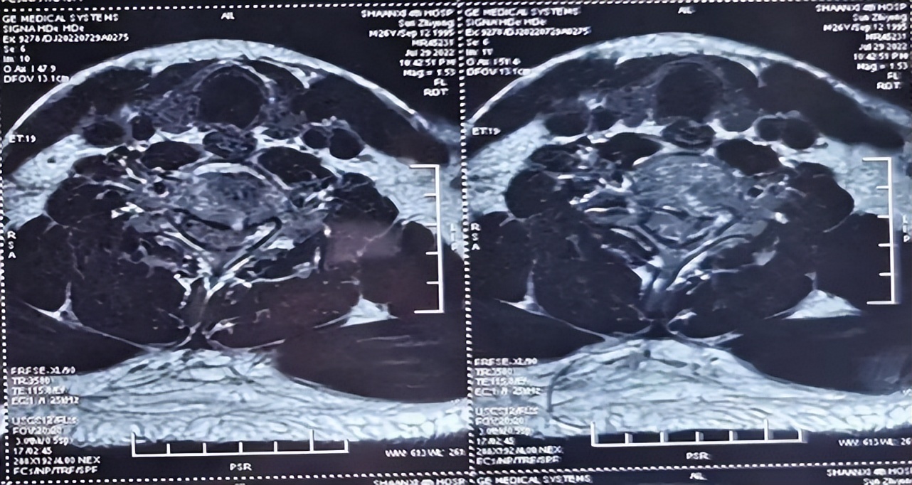 救治背部被砸伤男子,男子救人被砸中在icu抢救超24小时