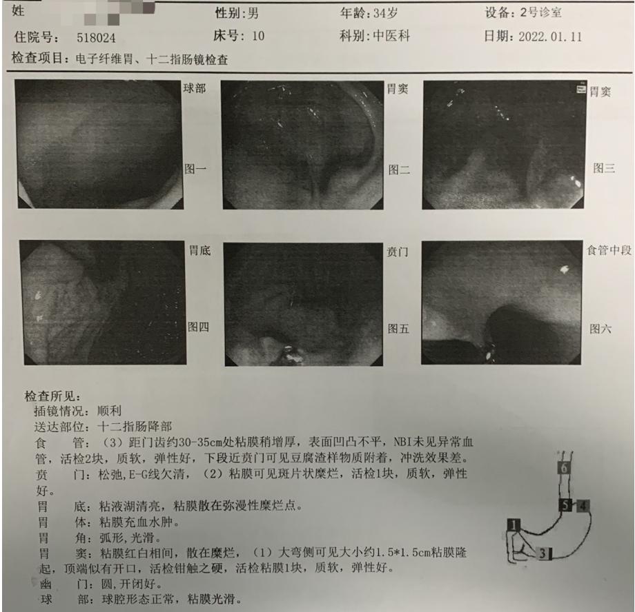 男23岁因上呼吸道感染剧烈咳嗽,34岁小伙咳嗽一个星期了