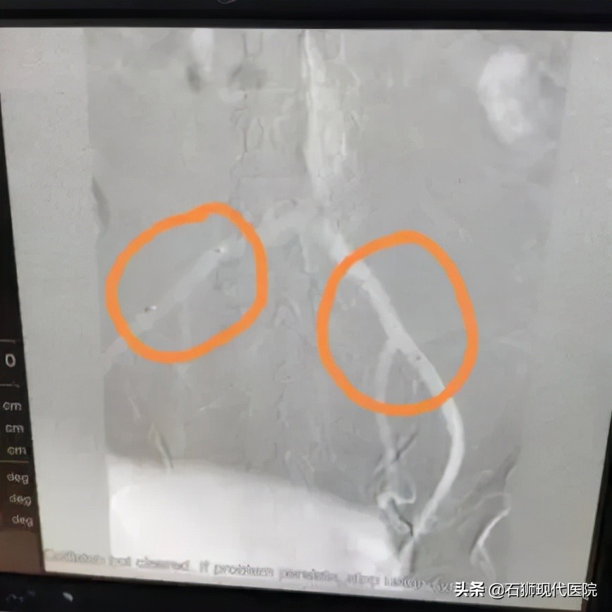 妇科微创手术示范,盆腔肿块案例