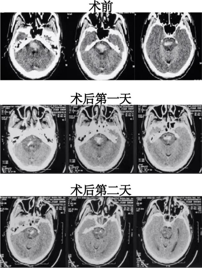 脑神经外科手术机器人,神经外科手术机器人投入使用了吗