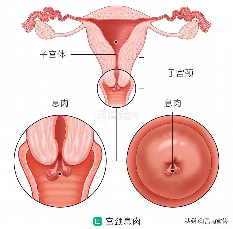 发现息肉，离癌有多远？