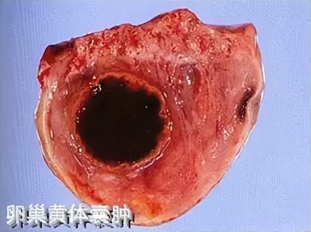 卵巢囊肿超声穿刺手术怎么做的,黄体囊肿与卵巢囊肿的超声区别