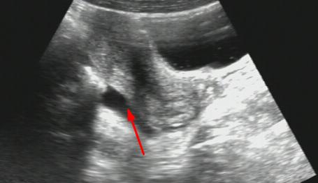 b超能查出盆腔肿瘤吗,B超能查出盆腔炎症吗