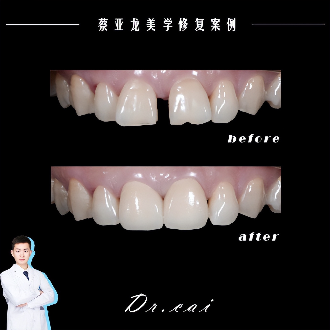 贵阳门牙牙缝大牙齿矫正,长沙牙齿疏松缝隙大矫正