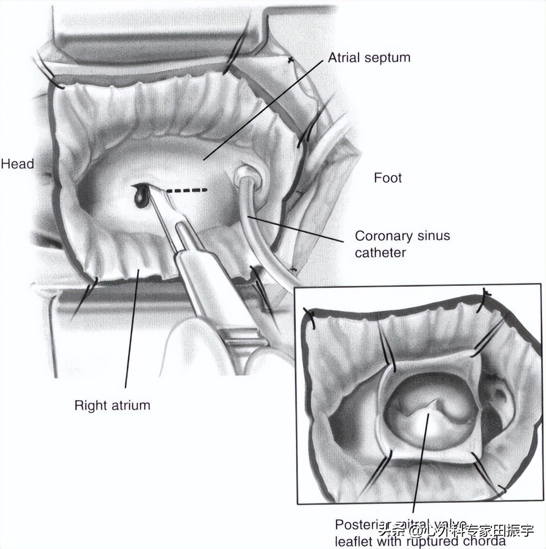 二尖瓣成形术,二尖瓣成形术后需要静养多久