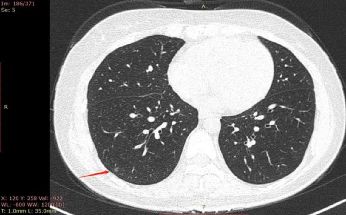 磨玻璃结节9*8mm建议随访,8mm磨玻璃结节一年没长