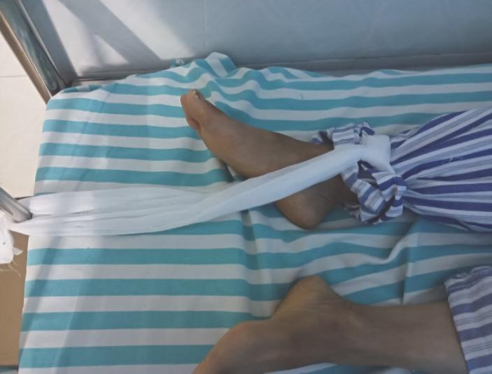 介入手术封堵器容易移位吗,介入封堵术可降解封堵器