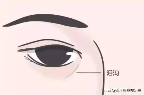眼袋分型及消除的方法,眼袋分型
