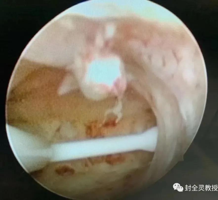 妇科专家教你认识宫腔镜,宫腔镜妇科主任