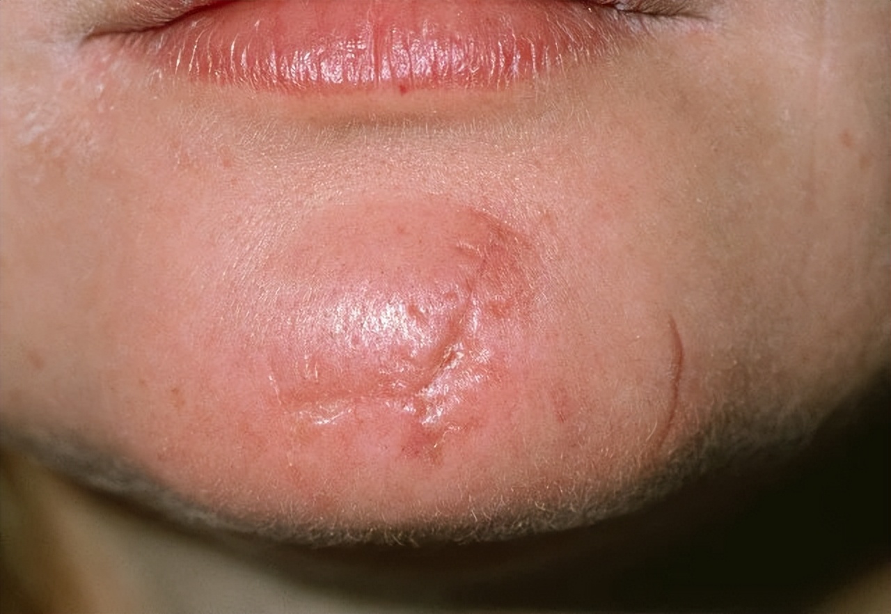 修复汽车凹陷疤痕的最好方法,凹陷疤痕修复手术一般多少钱