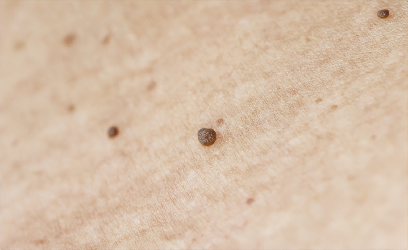 头皮里,老是长疙瘩和脓包,是怎么了?是病吗?告诉你答案