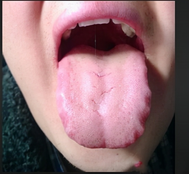 中医四诊中的正常舌象,中医看舌象准还是摸脉准