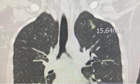 70%磨玻璃肺结节无需着急手术,磨玻璃结节5mm医生说原位癌