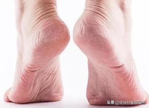 冬天父母手皲裂怎么办,冬天中老年人手脚皲裂