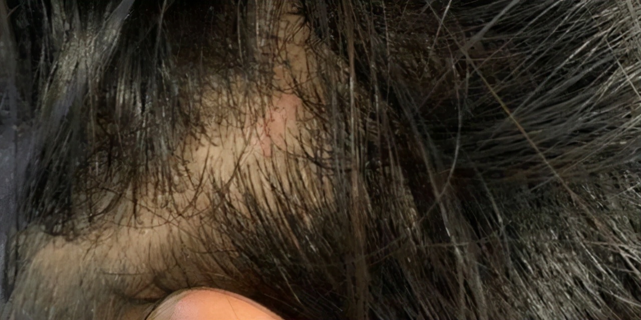 头部发炎,如何预防头部发炎的疾病