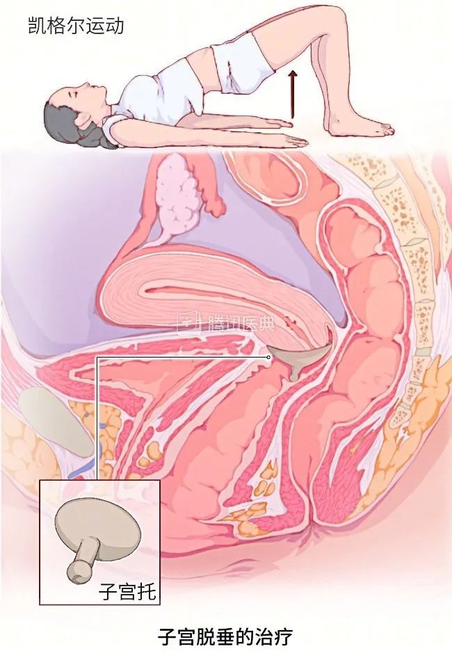 “医生，我觉得有东西从阴道掉下来……”