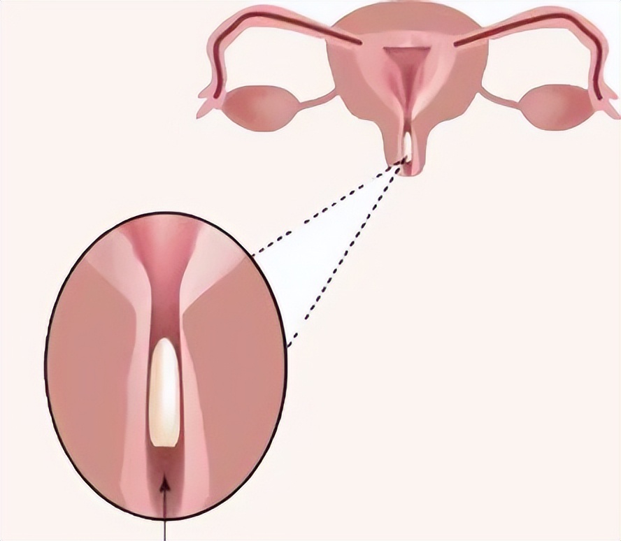 鍚冨畬绁炵鑽父鍚庣画,鍚冧笅鑳跺泭鐨勬亹鎬栫墖