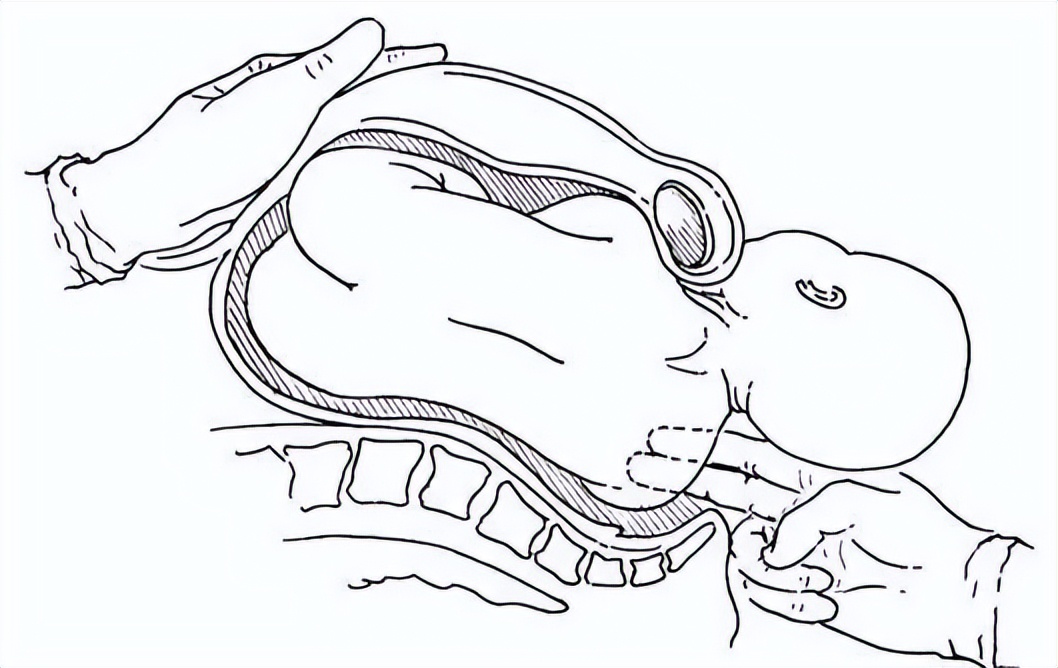 巨大儿危害不容忽视,二附院有多厉害