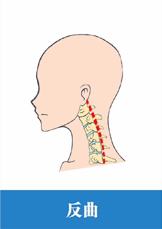 诊断颈椎曲度变直一年了能恢复吗,颈椎曲度变直又反弓如何恢复