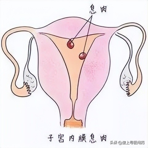 绝经十几年了出现囊肿,绝经6年出血有实性肿块