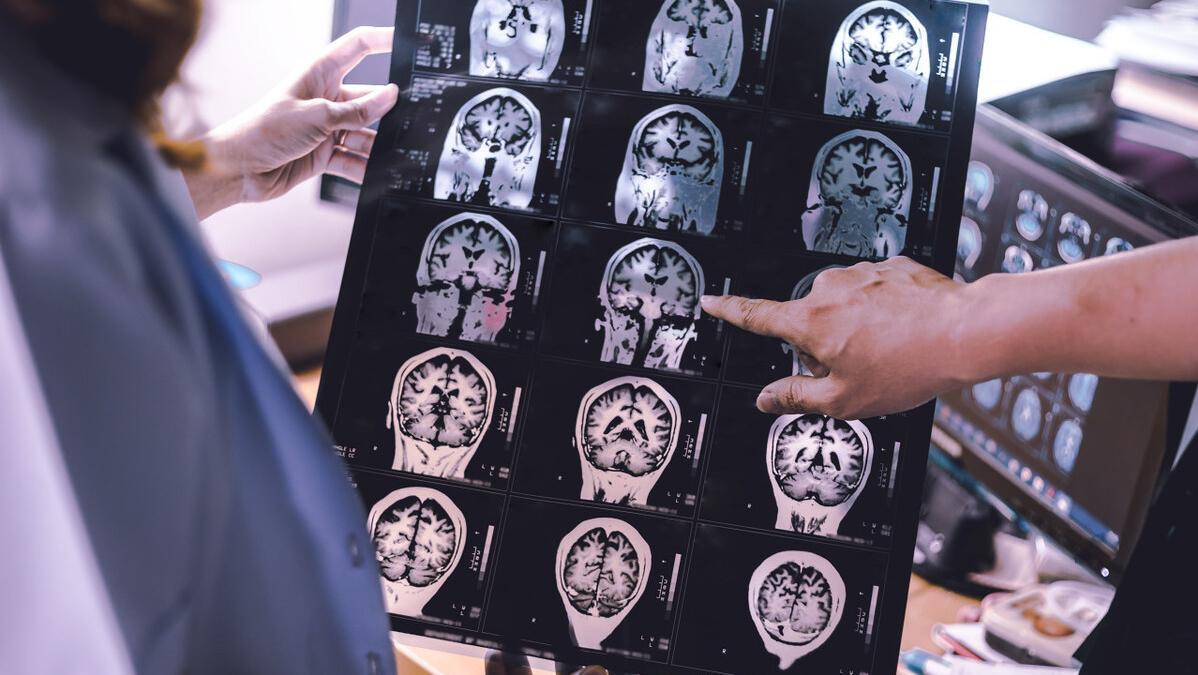 哪种药用来治脑萎缩,担心脑萎缩如何延缓脑的衰老