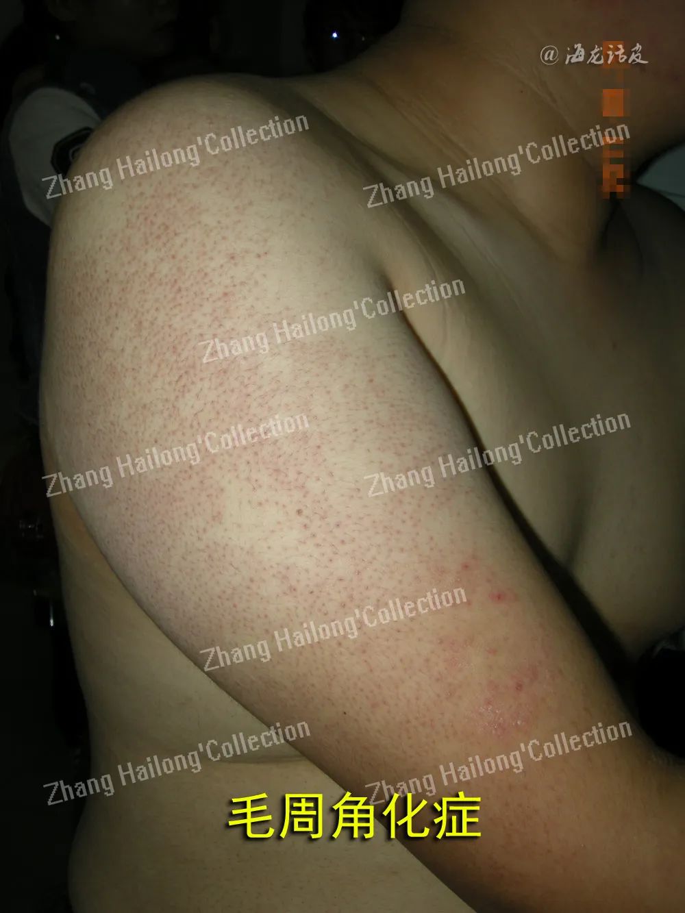 如何拯救鸡皮肤,如何拯救油腻鸡皮肤