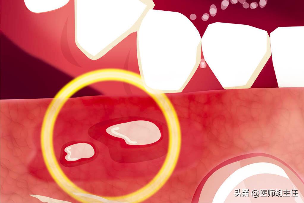 有一种痛叫口腔溃疡,有一种痛叫口腔溃疡动画片