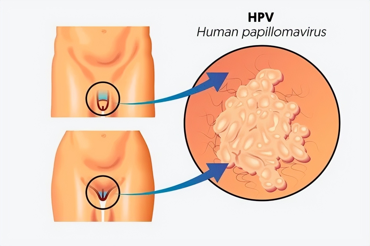 身上有5种疣,长了瘊子就一定是感染了hpv病毒吗