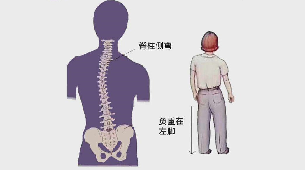 脊柱侧弯保守治疗可以报销吗,脊柱侧弯手术15万能报销多少