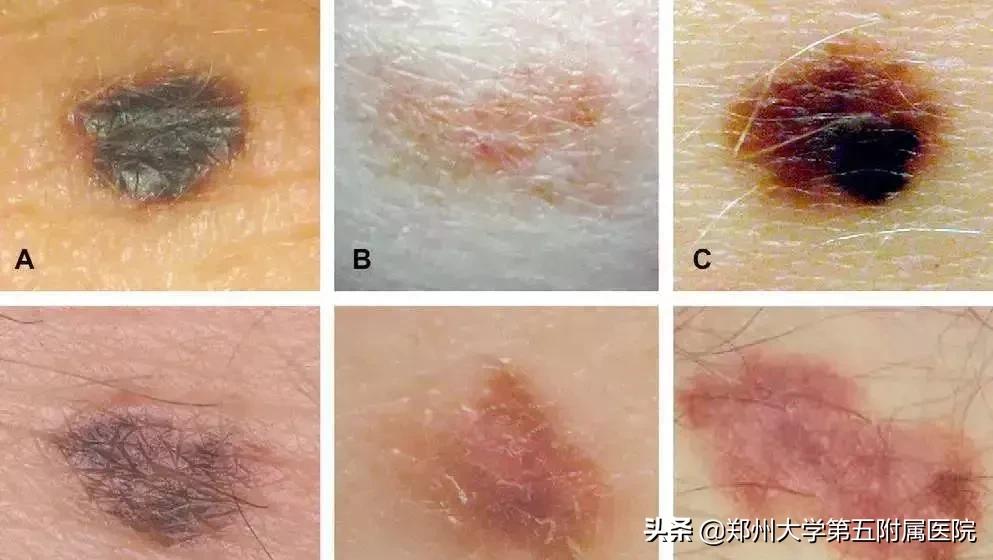 激光祛痣祛得彻底吗,激光祛痣法真的有用吗