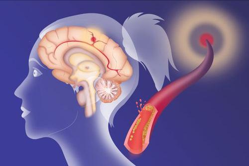 中医对中风的认知和康复方法,脑中风跟癫痫有什么区别