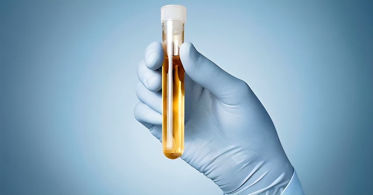 肌酐730其他指标都还好需要透析吗,尿毒症肌酐指标多少可以不用透析