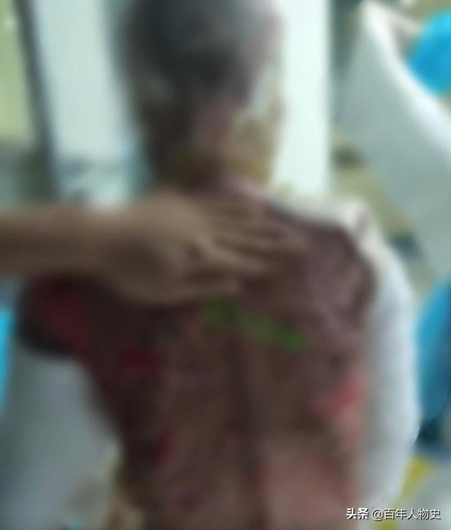 19年,四川20岁女孩遭大火毁容48%烧伤,双臂截肢如今怎么样了?