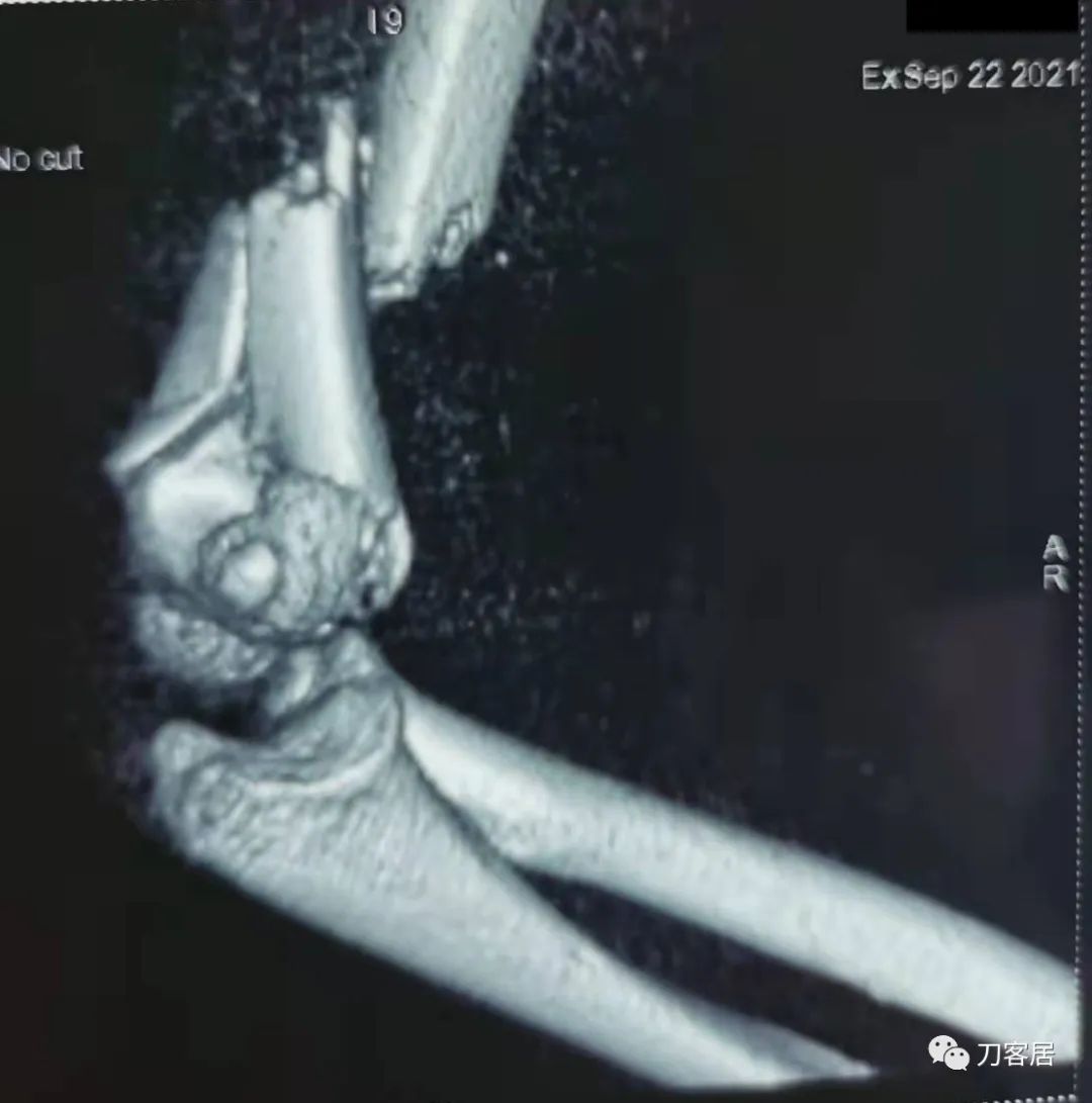 孩子胳膊摔伤肿了不能弯曲一直疼,9岁男孩摔倒手臂痛怎么办