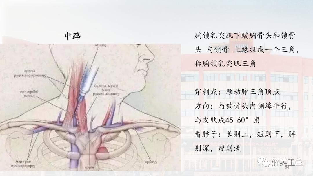 深静脉穿刺置管术讲解ppt,中心静脉穿刺置管深度