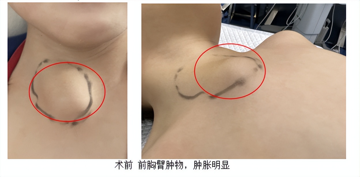 儿童腹部淋巴管瘤微创多久能下床,婴儿颈后淋巴管瘤介入治疗