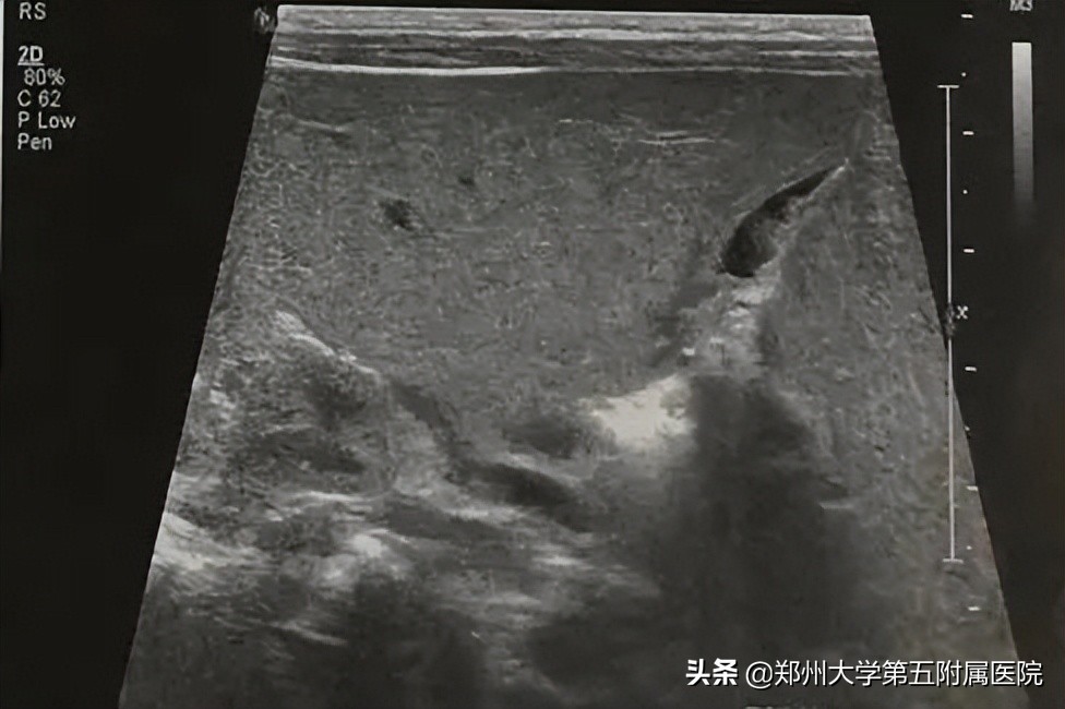 黄疸患者如何用超声诊断与鉴别,小儿黄疸超声筛查