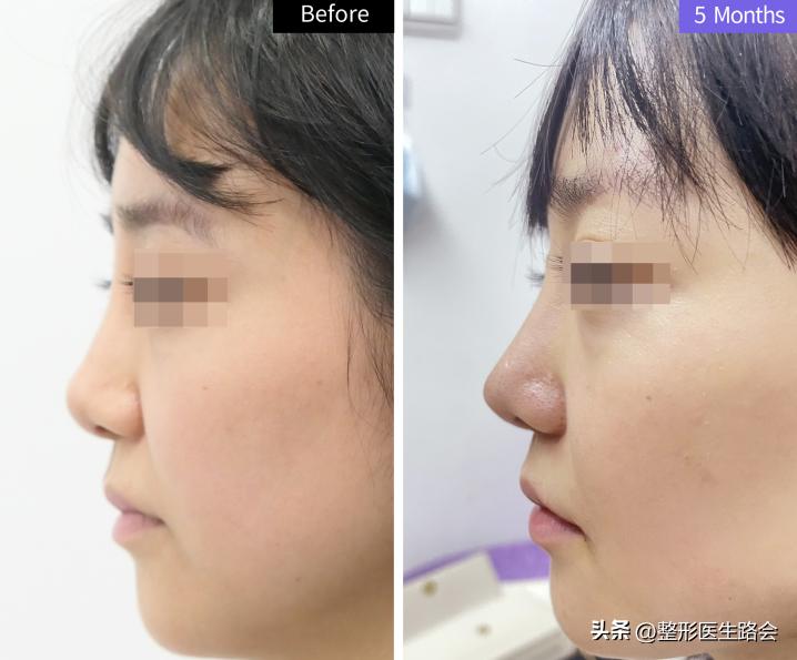 隆鼻到底要不要只做鼻头,隆鼻前要检查哪些项目