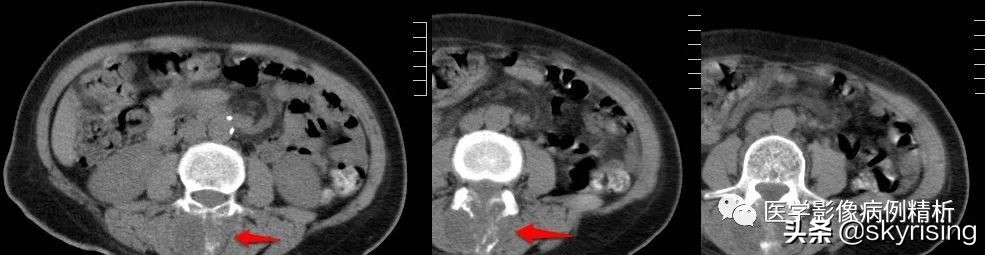 脊索瘤造成骨质破坏严重吗,多发椎体骨质破坏考虑转移瘤