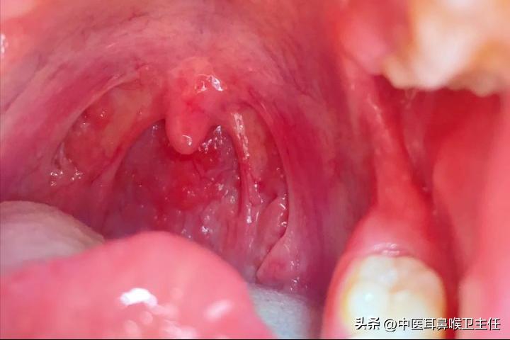 咽喉炎可以用中医调理吗,咽喉炎嗓子疼干咳怎么办