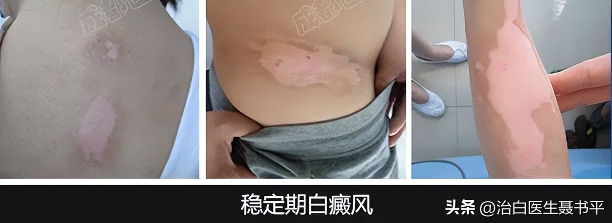 他克莫司软膏治疗白癜风怎么涂,他克莫司软膏用多久可以治白癜风