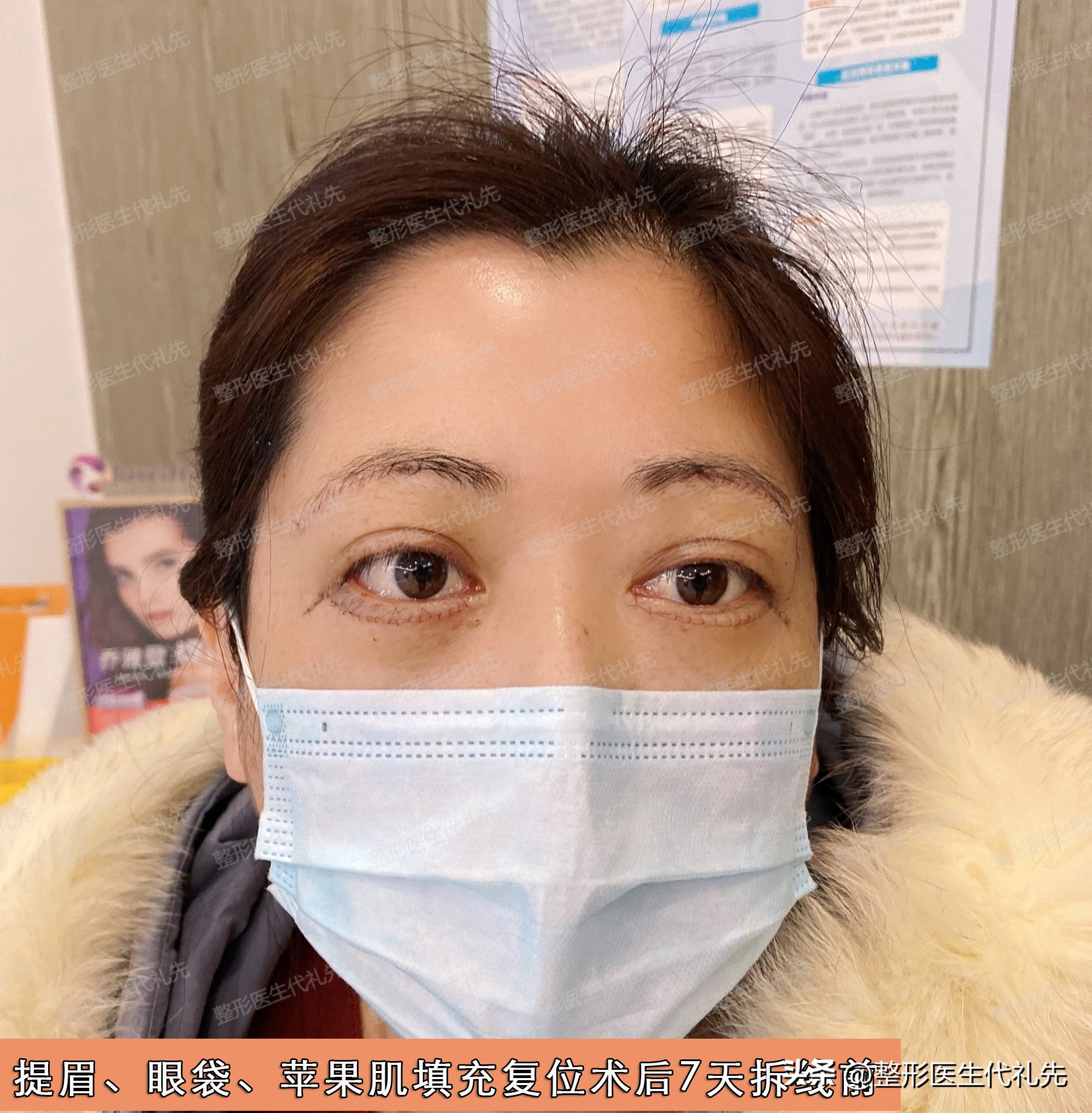 祛眼袋手术后有细纹会慢慢恢复吗,祛眼袋两年后眼睛凹陷怎么办