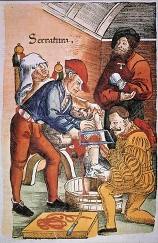 中世纪理发师外科医生,中世纪放血治疗法