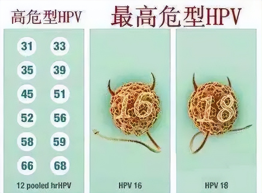 感染了hpv一定会变为癌症吗,感染了hpv一定会得宫颈癌吗