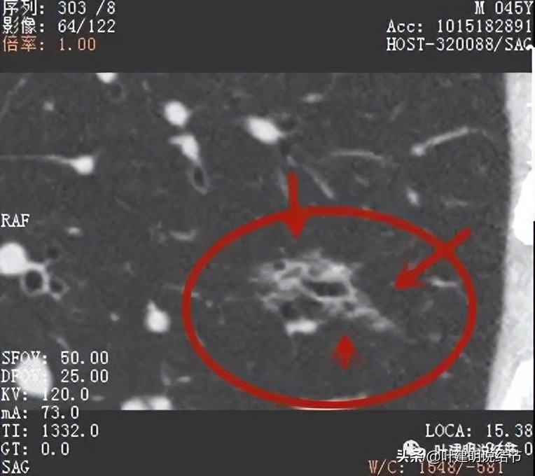 误诊肺纤维化,肺蜂窝状是癌吗